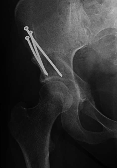 pao surgery hip